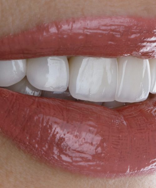 perfect smile of a girl with veneers and beautiful lipstick perfect smile of a girl with veneers and beautiful lipstick